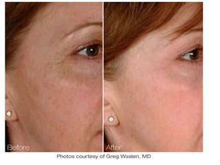 pore reduction skin rejuvenation nyc